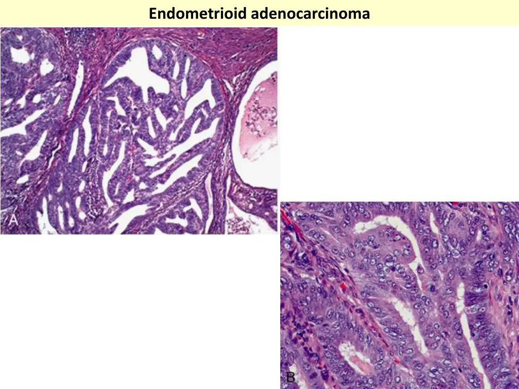 endometrioid adenocarcinoma