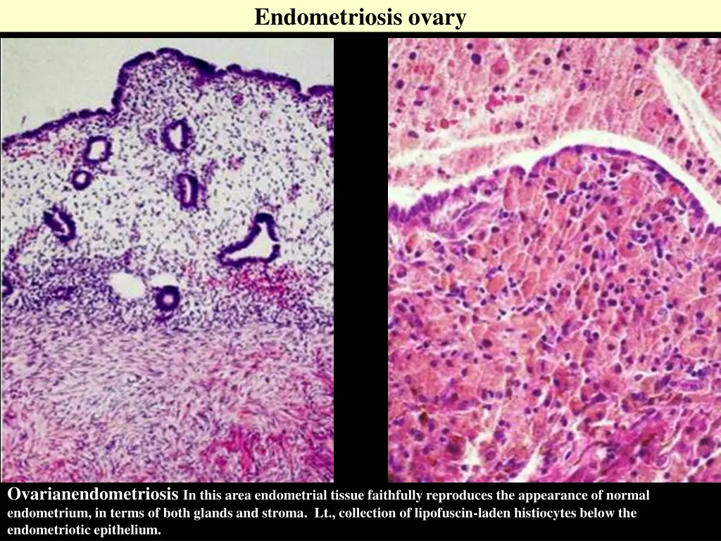 endometriosis ovary 1