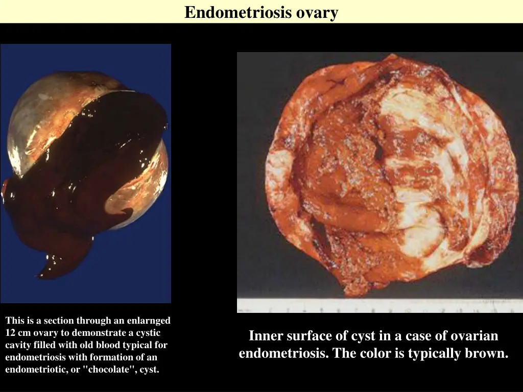 endometriosis ovary