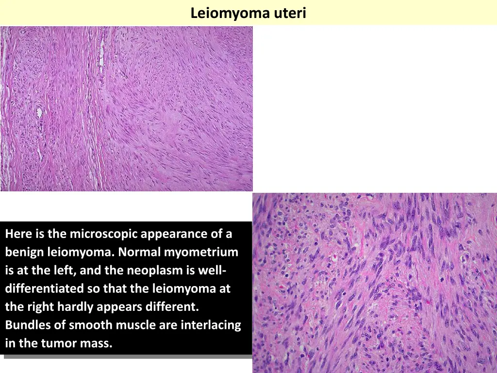 leiomyoma uteri