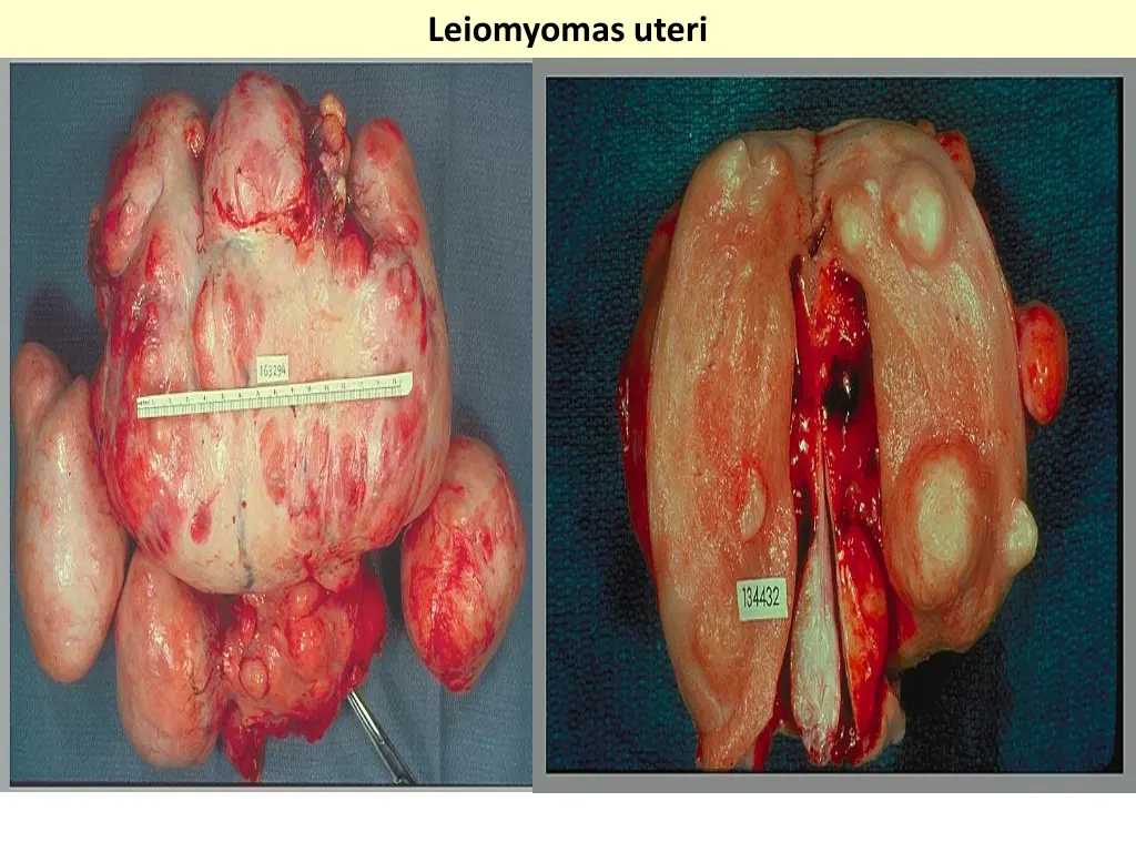 leiomyomas uteri