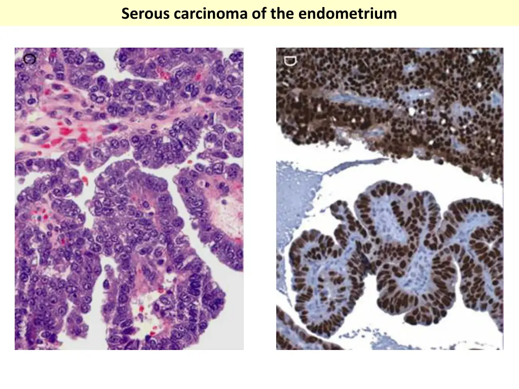 serous carcinoma of the endometrium