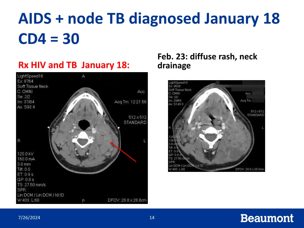 aids node tb diagnosed january 18 cd4 30