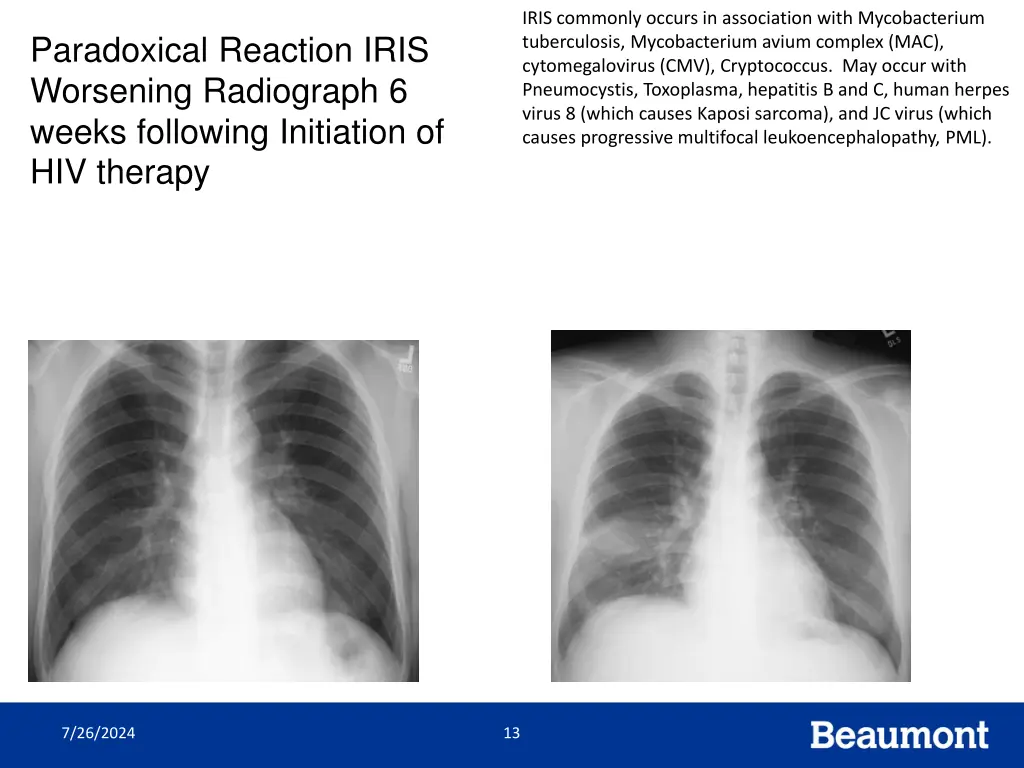 iris commonly occurs in association with