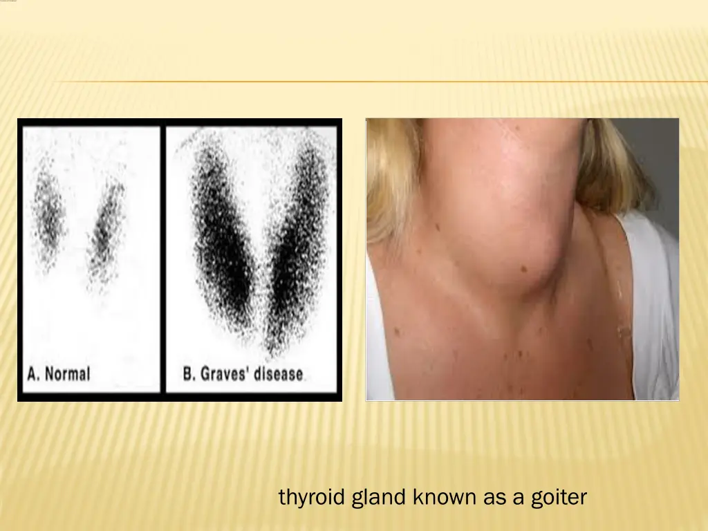 thyroid gland known as a goiter