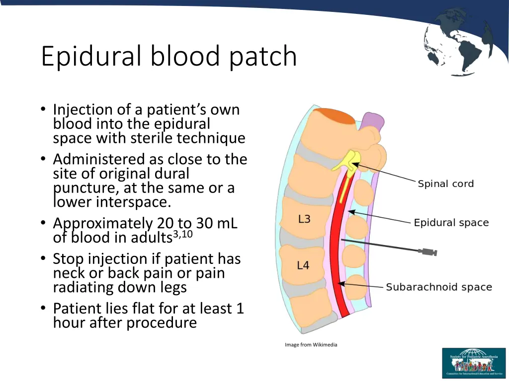 epidural blood patch 3