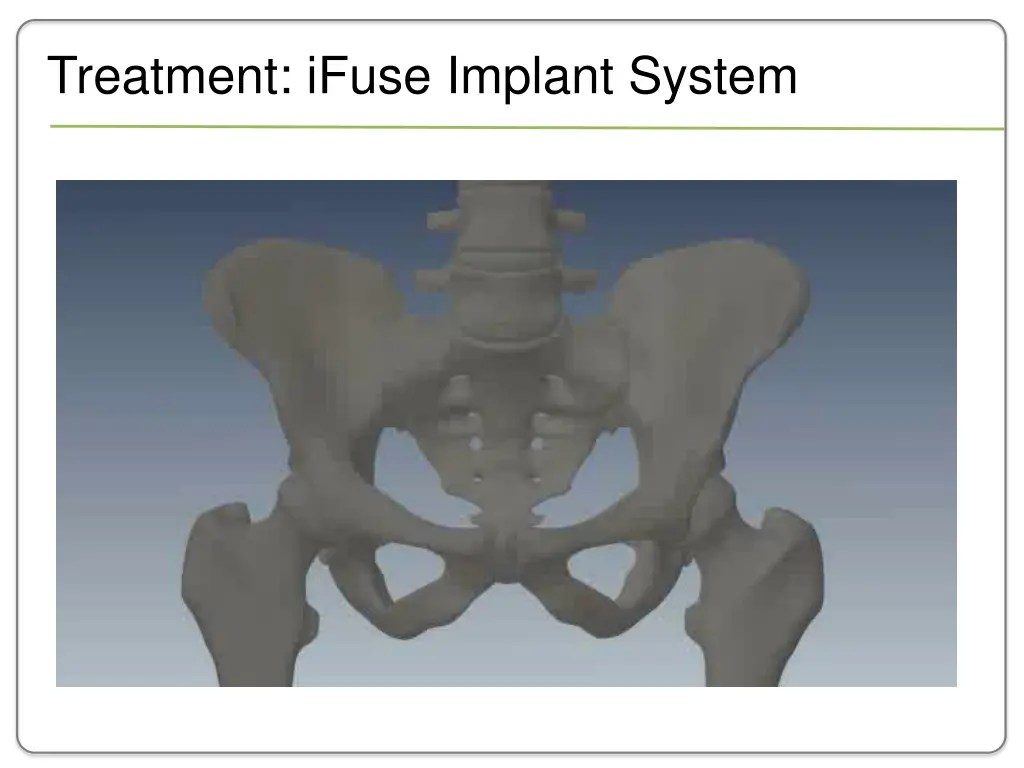 treatment ifuse implant system 1