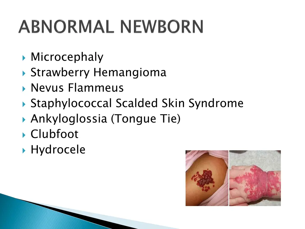 microcephaly strawberry hemangioma nevus flammeus