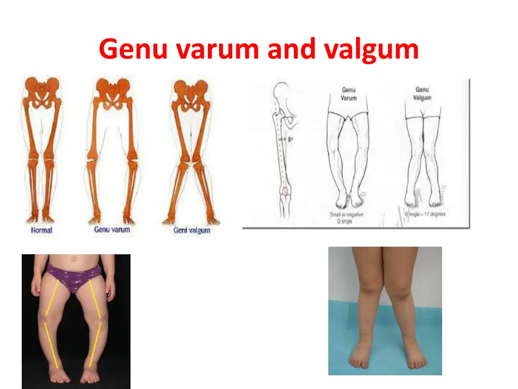 genu varum and valgum