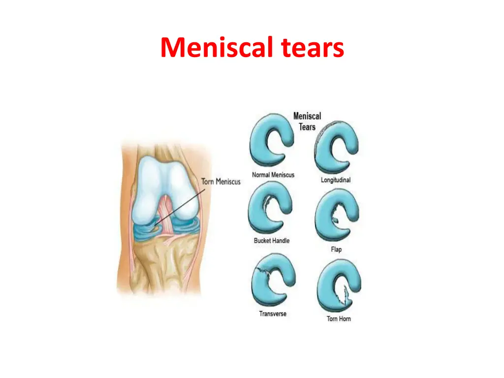 meniscal tears