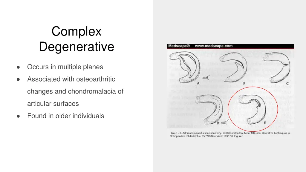 complex degenerative