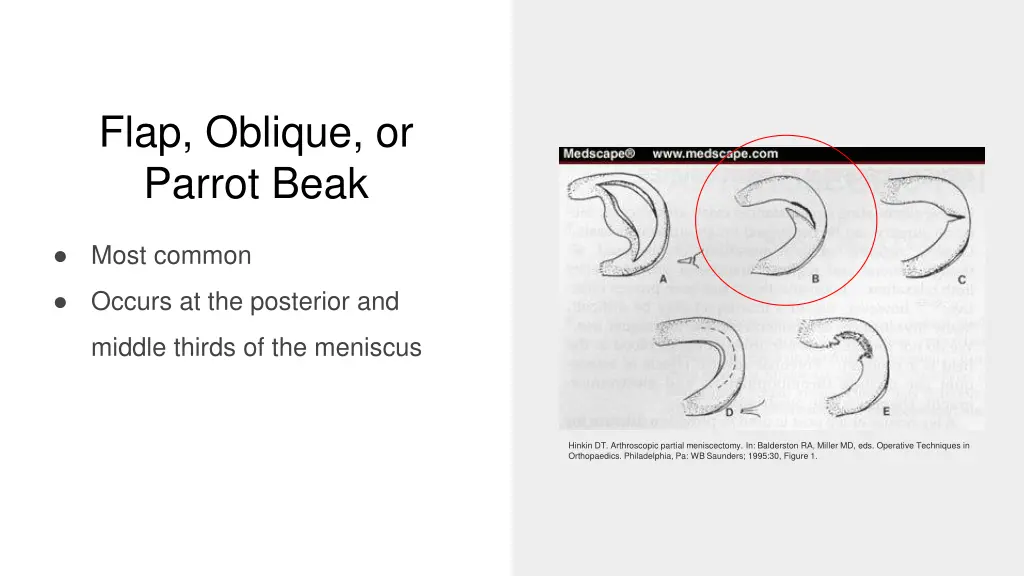 flap oblique or parrot beak