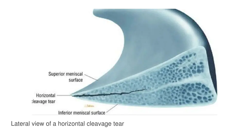 lateral view of a horizontal cleavage tear