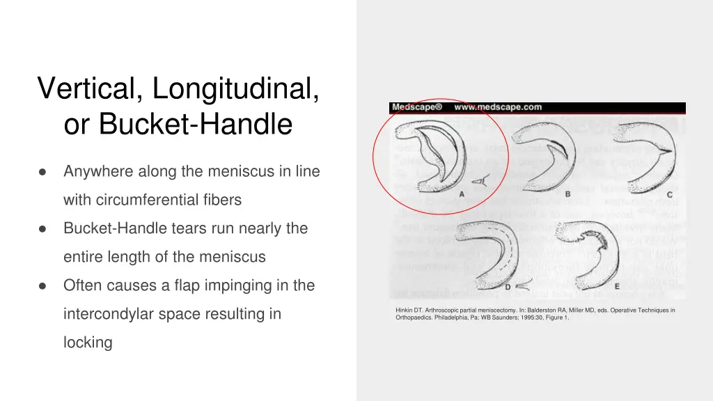 vertical longitudinal or bucket handle