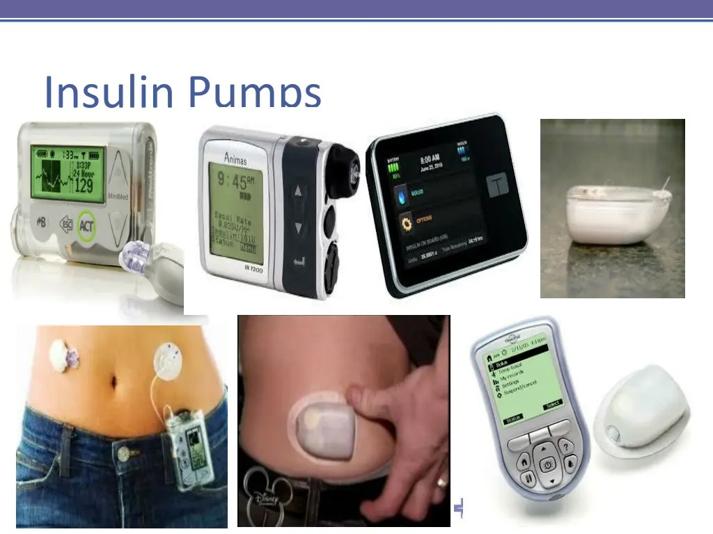 insulin pumps