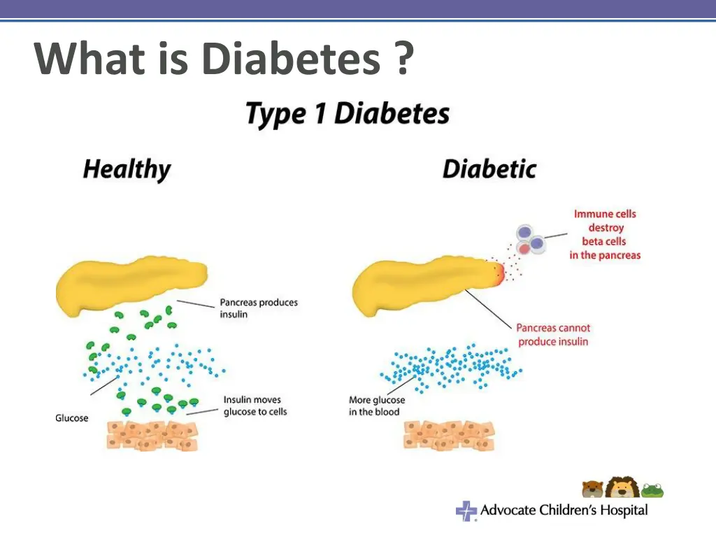 what is diabetes 1