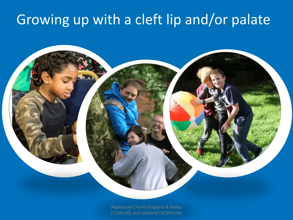 growing up with a cleft lip and or palate