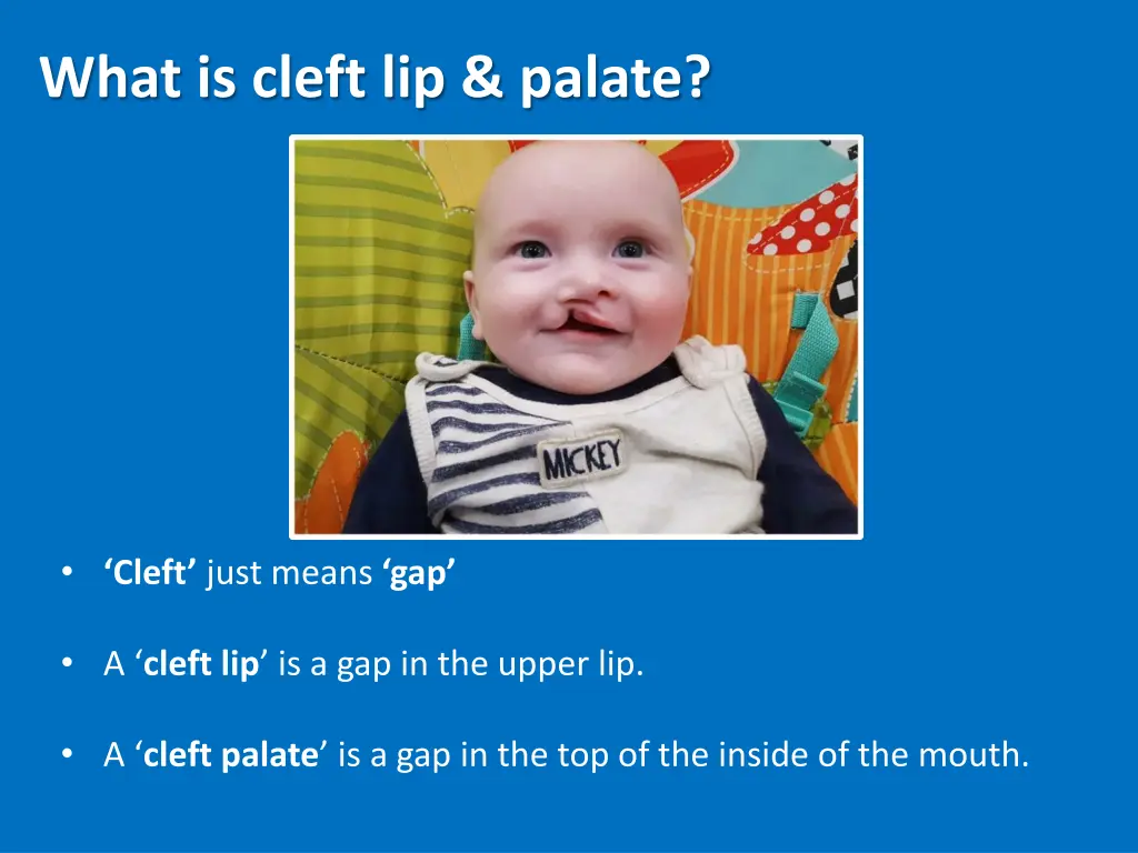 what is cleft lip palate