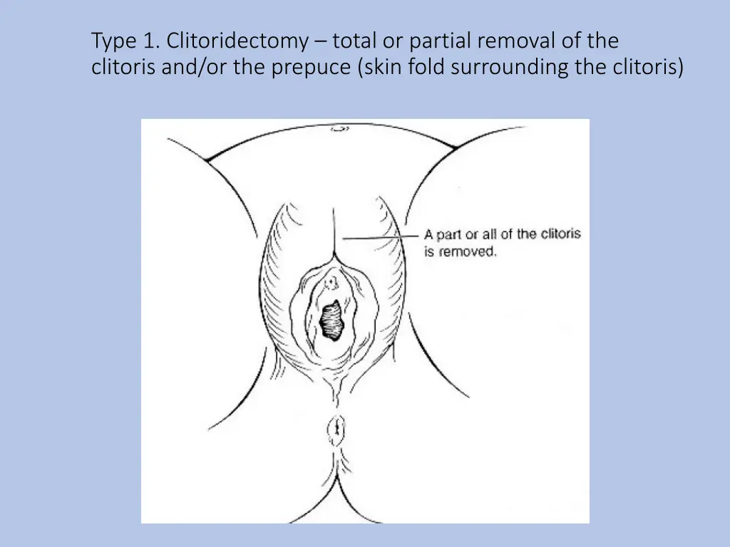 type 1 clitoridectomy total or partial removal