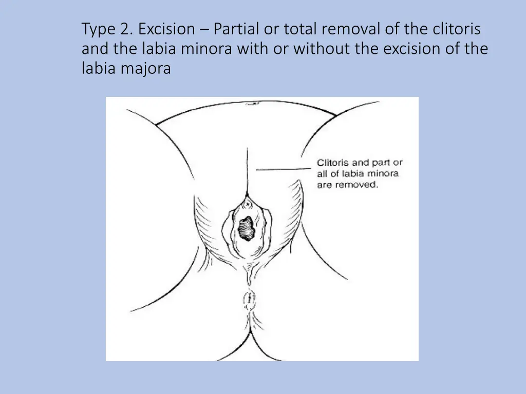 type 2 excision partial or total removal