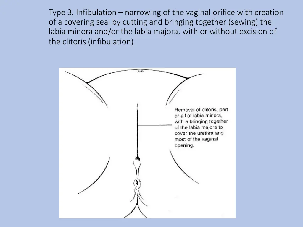 type 3 infibulation narrowing of the vaginal