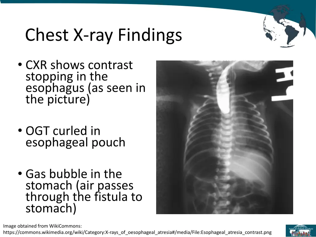 chest x ray findings