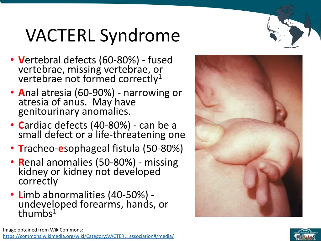 vacterl syndrome