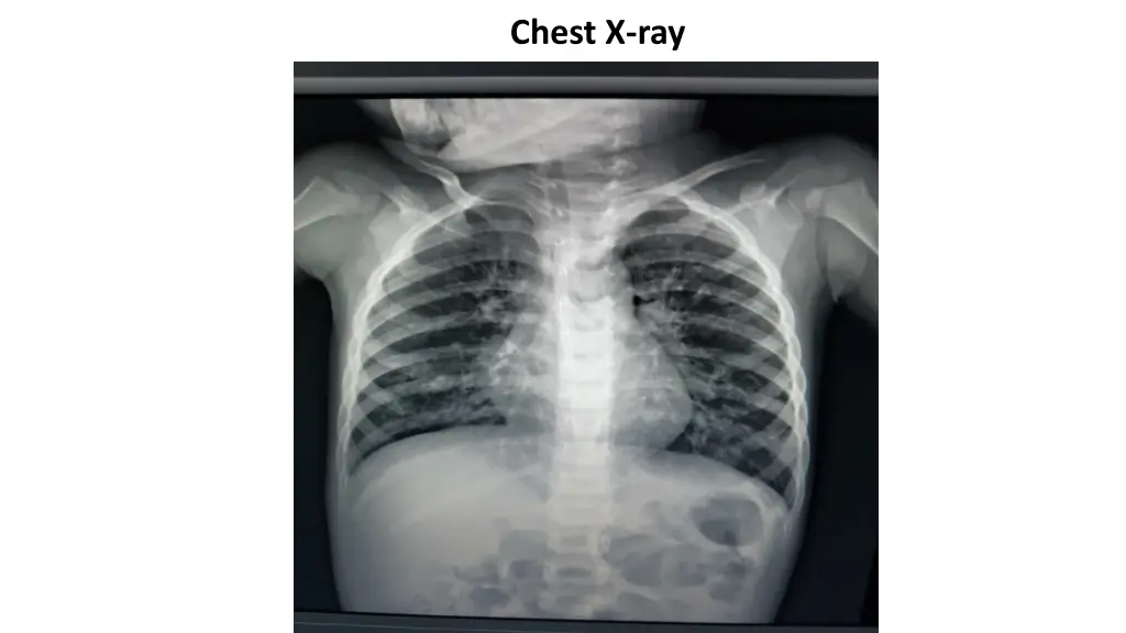 chest x ray