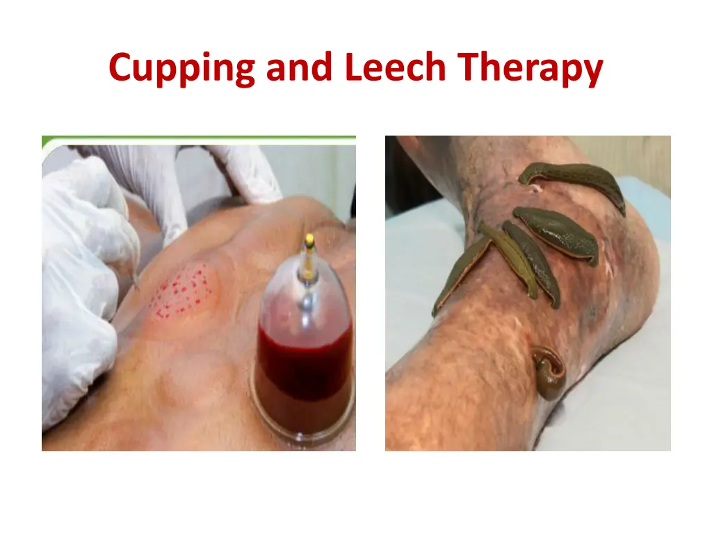 cupping and leech therapy