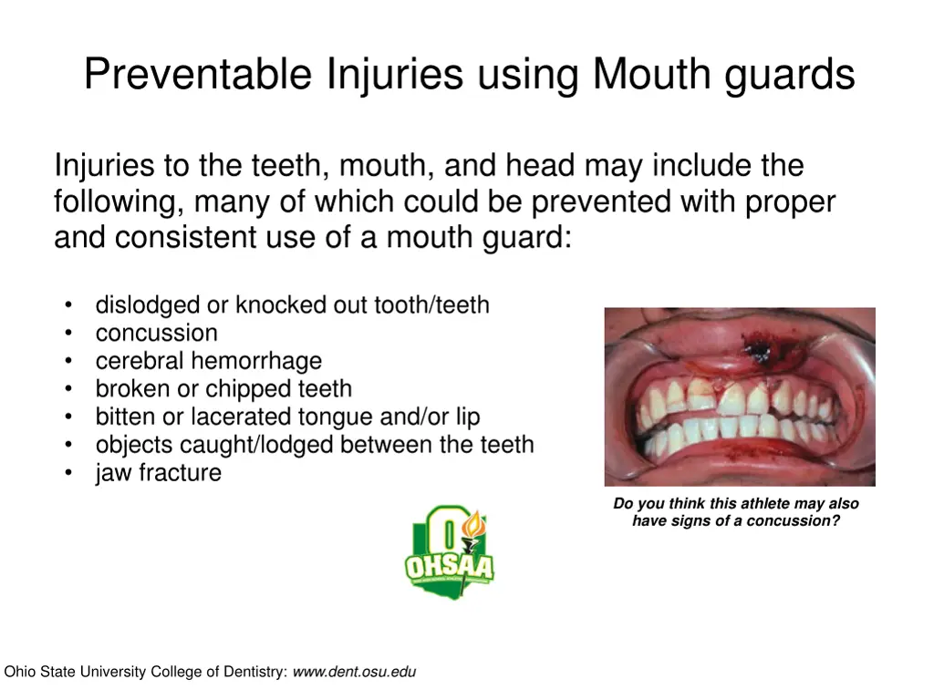 preventable injuries using mouth guards