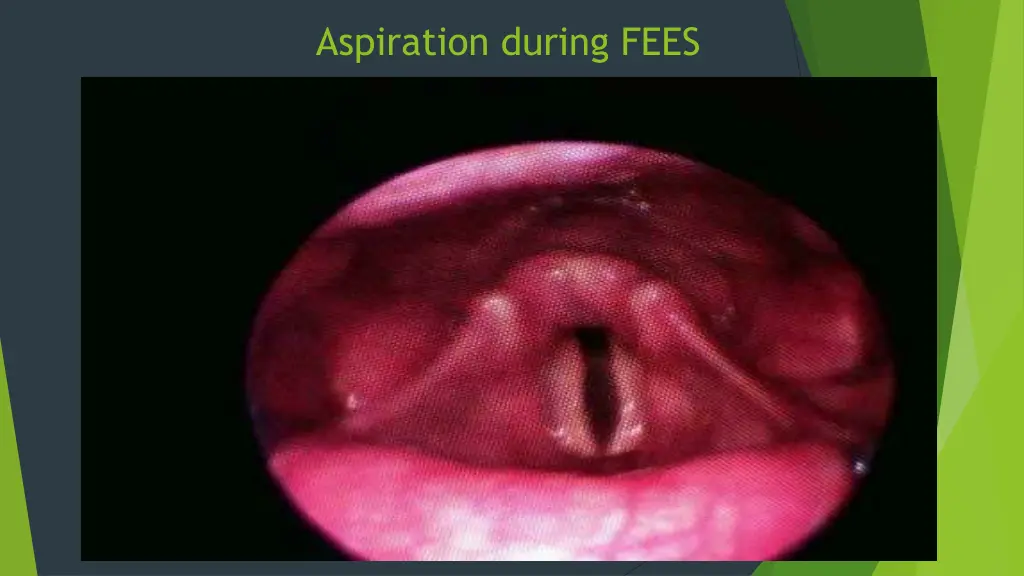 aspiration during fees