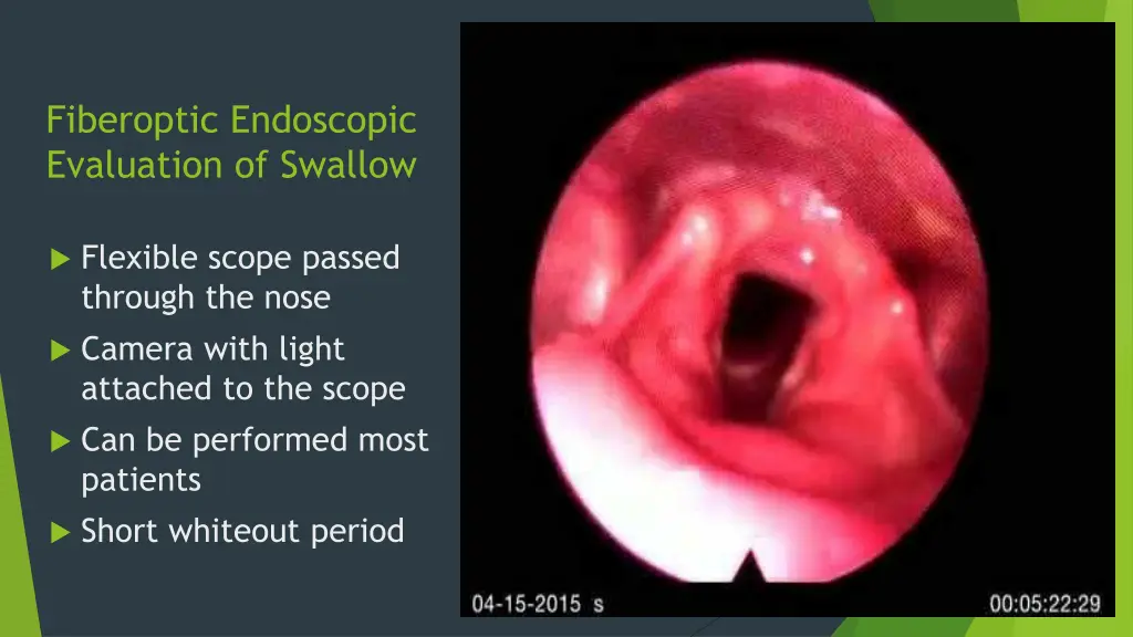 fiberoptic endoscopic evaluation of swallow