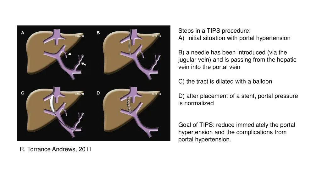 steps in a tips procedure a initial situation