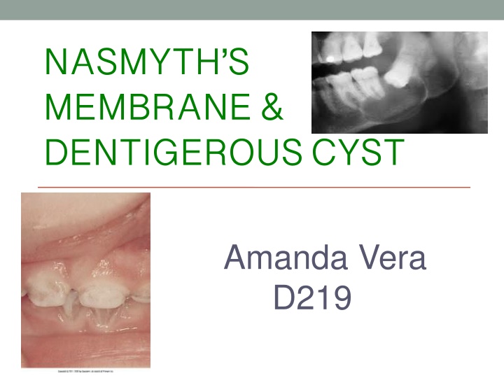 nasmyth s membrane dentigerouscyst