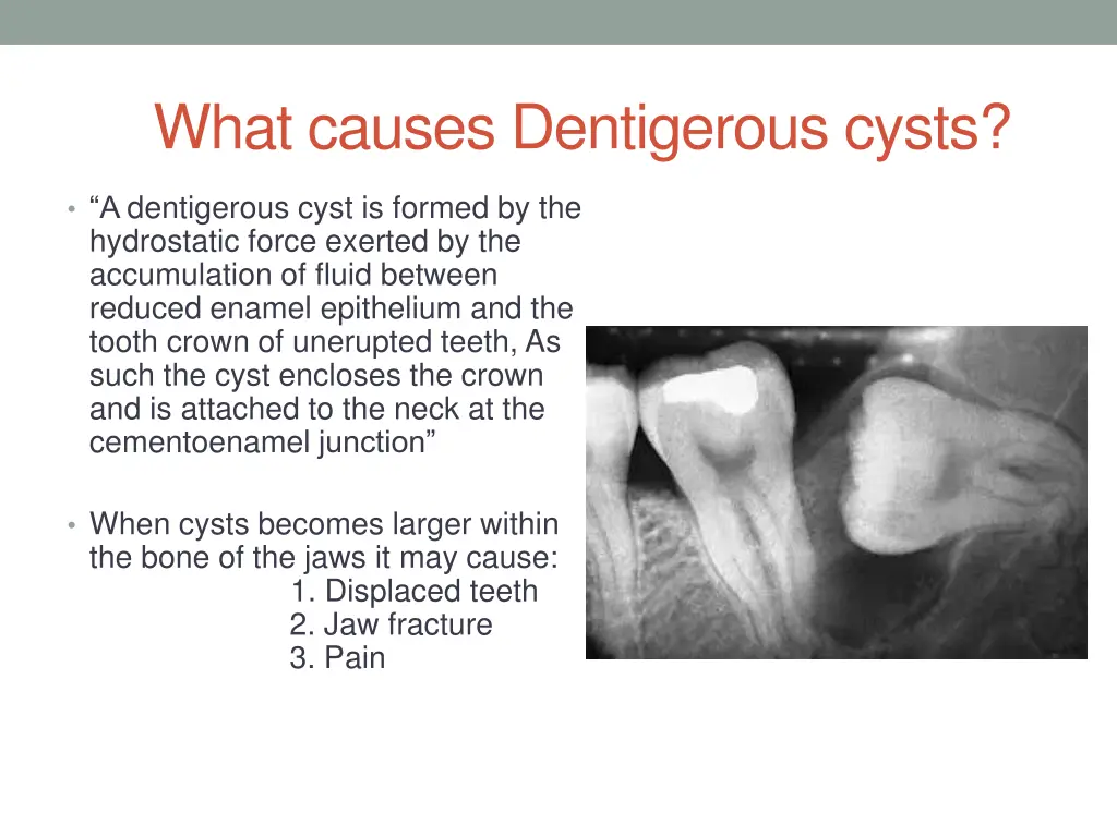 what causes dentigerous cysts