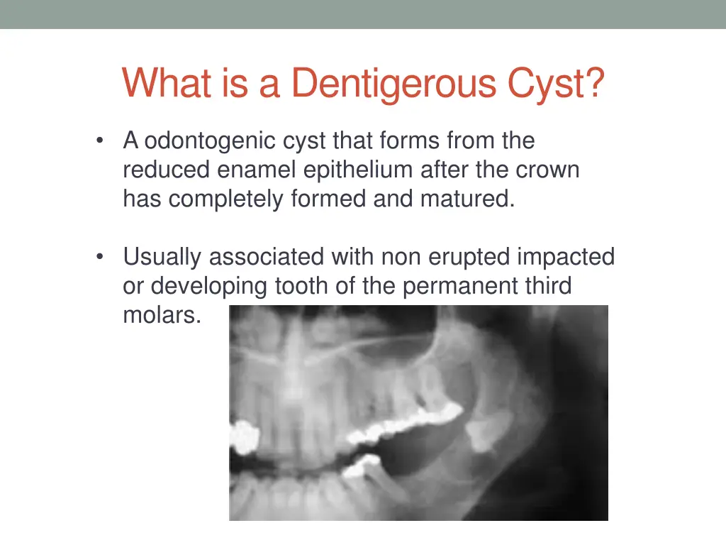 what is a dentigerous cyst