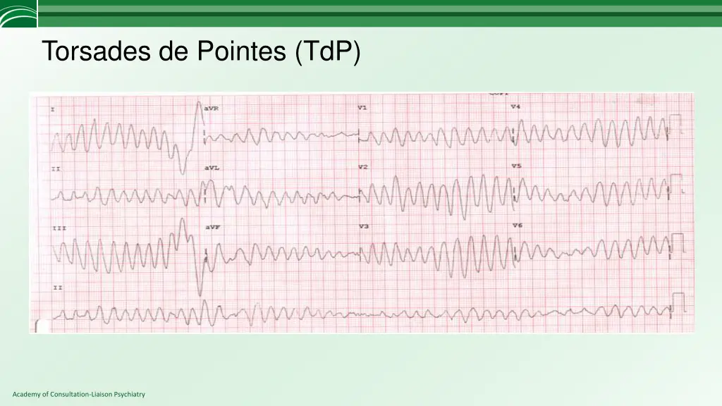 torsades de pointes tdp