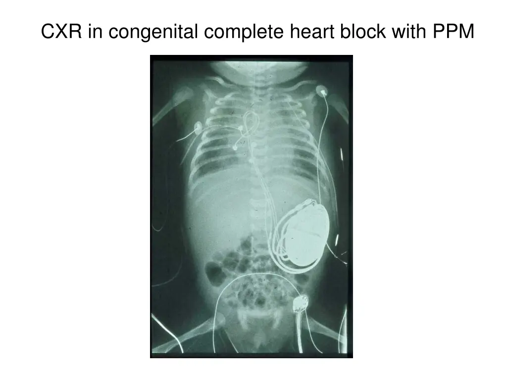 cxr in congenital complete heart block with ppm