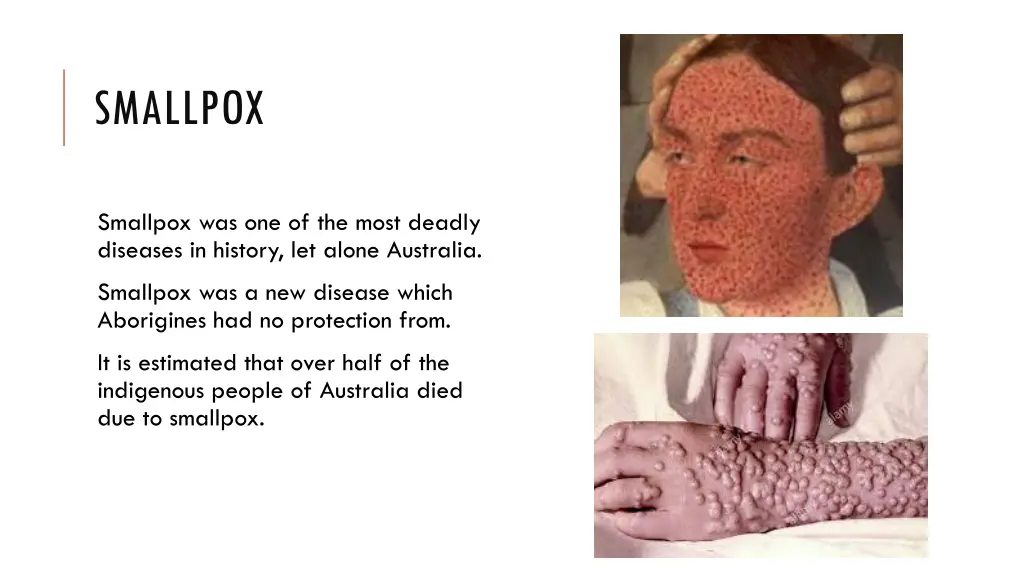 smallpox