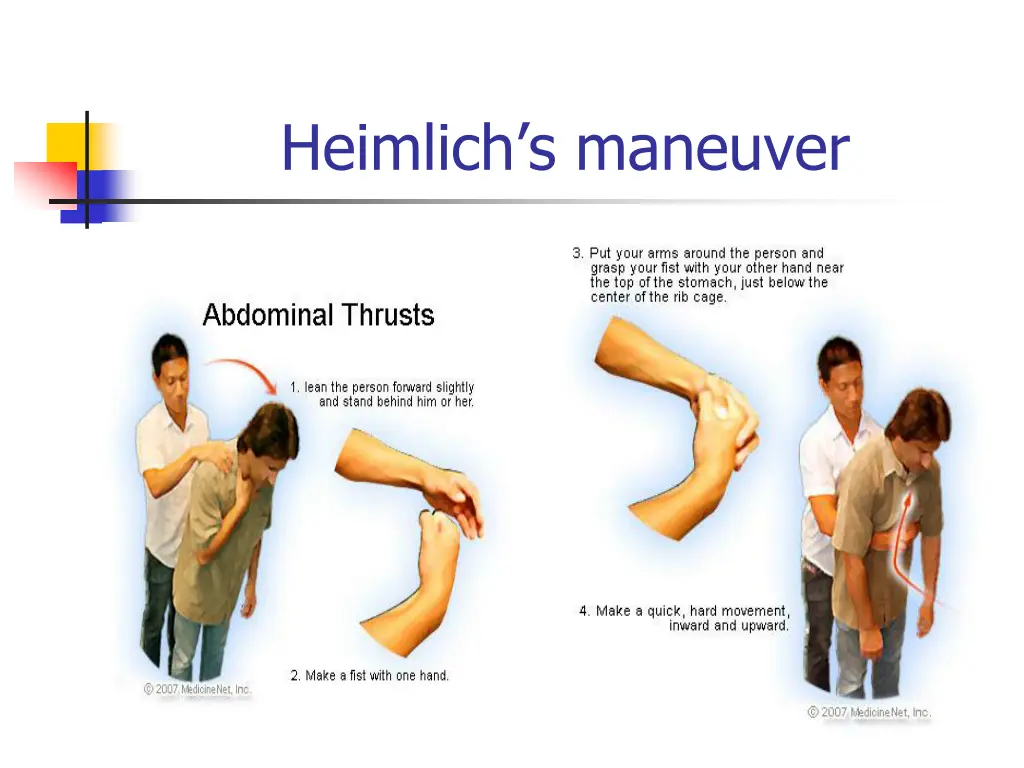 heimlich s maneuver