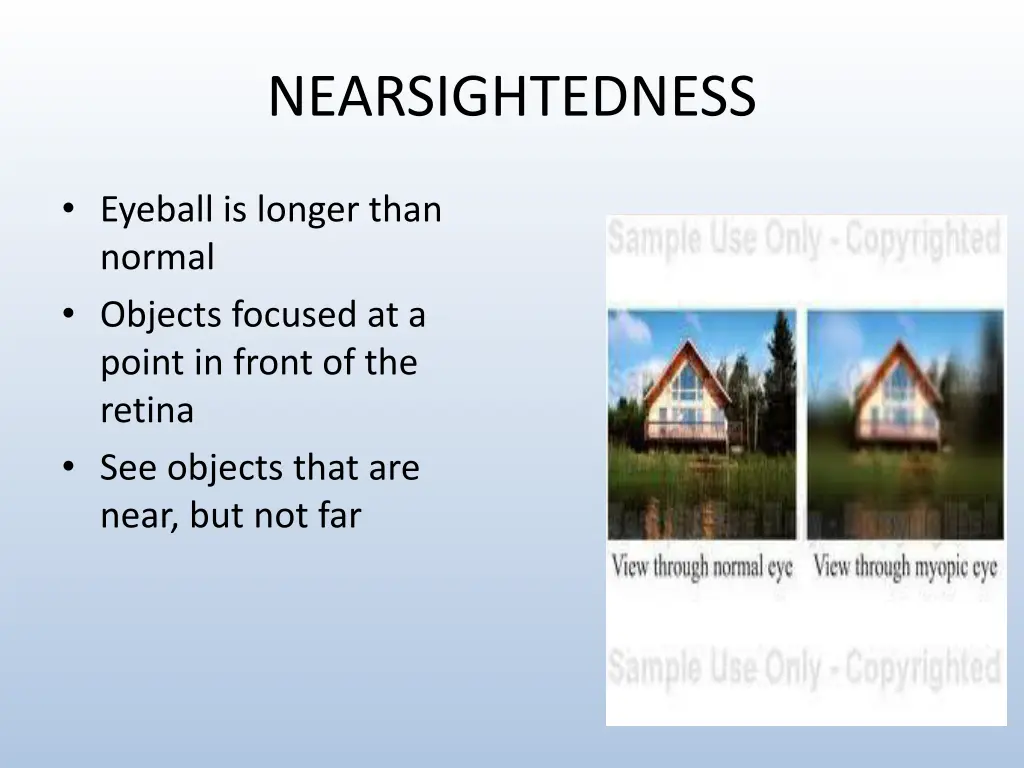 nearsightedness