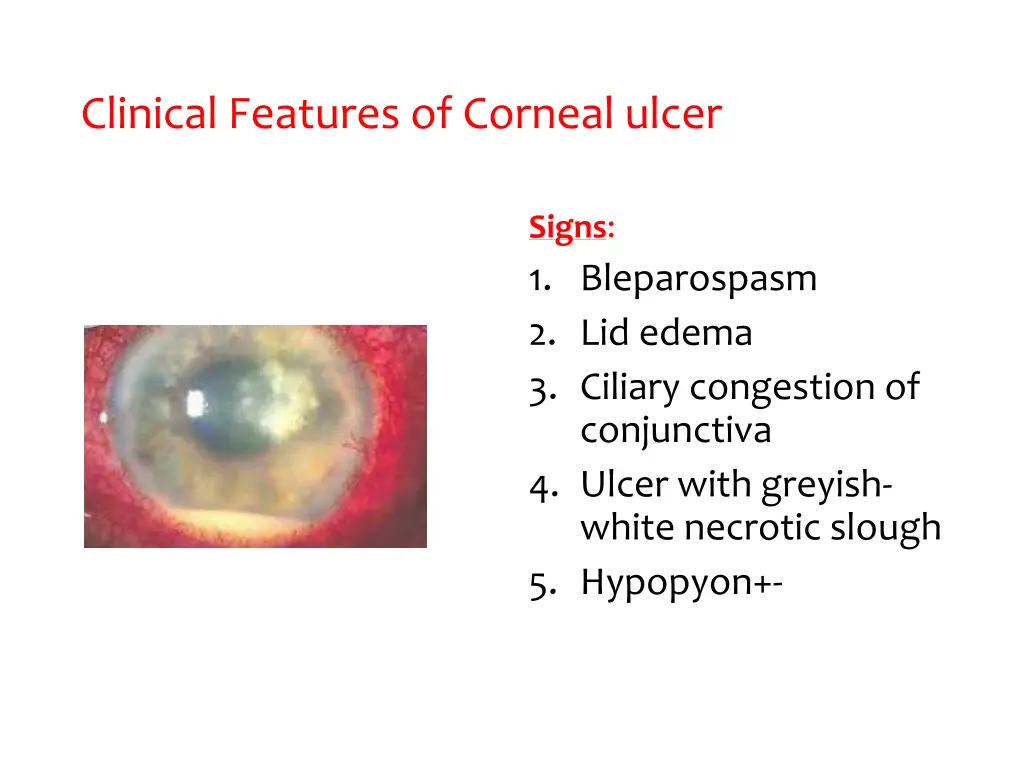 clinical features of corneal ulcer 1