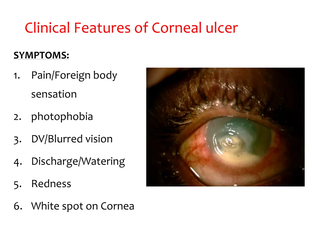 clinical features of corneal ulcer