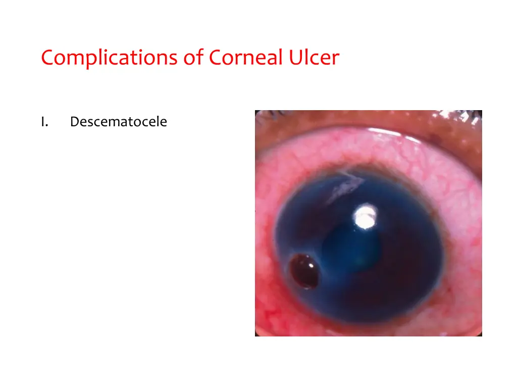 complications of corneal ulcer