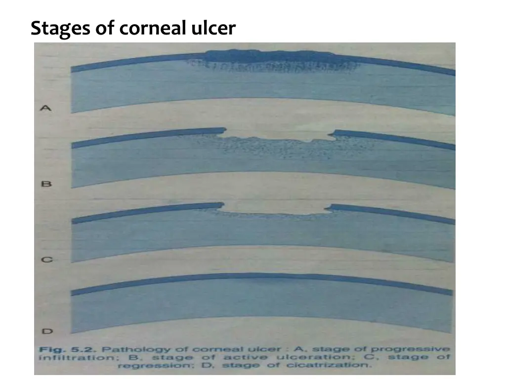 stages of corneal ulcer