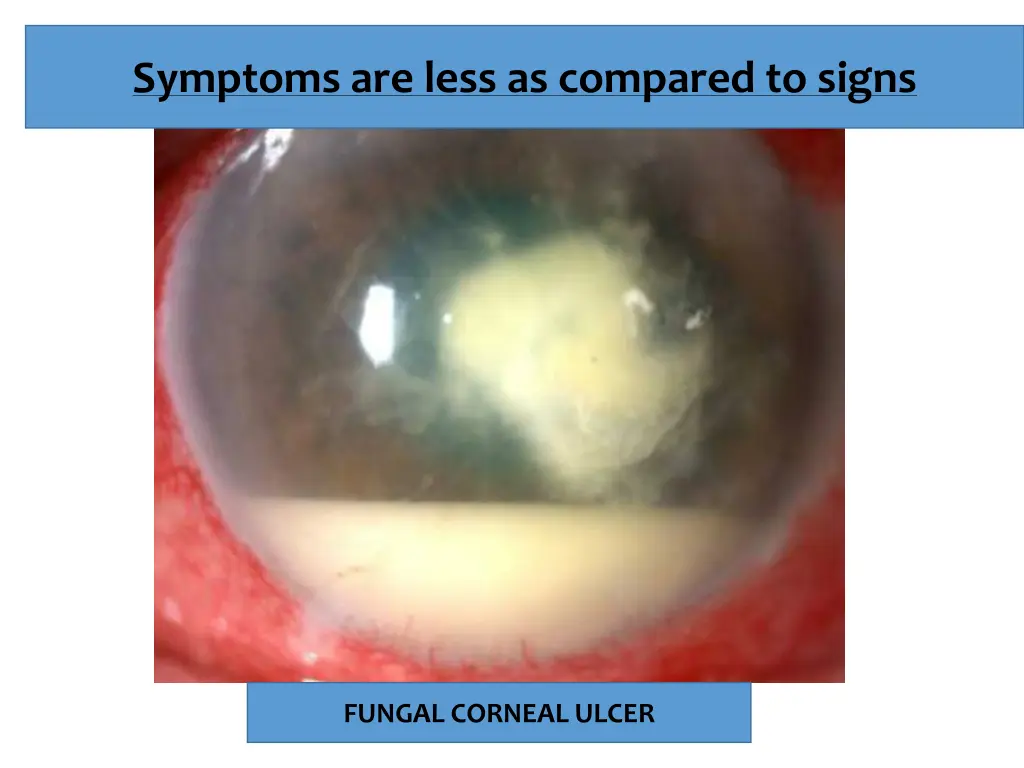 symptoms are less as compared to signs