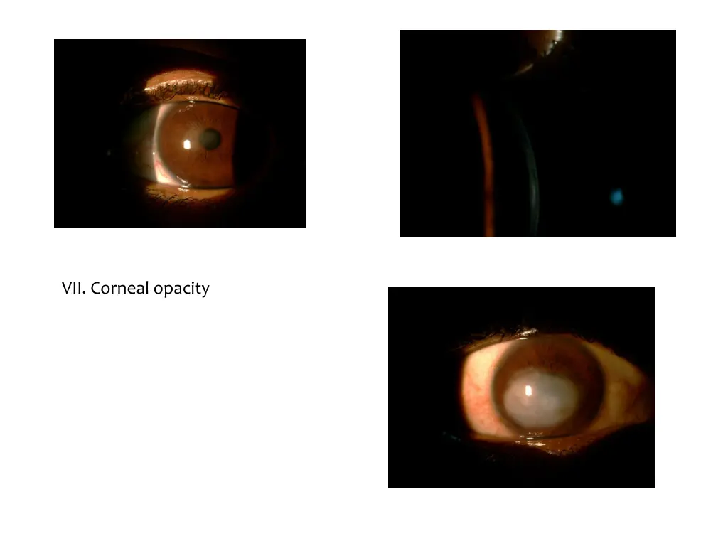 vii corneal opacity