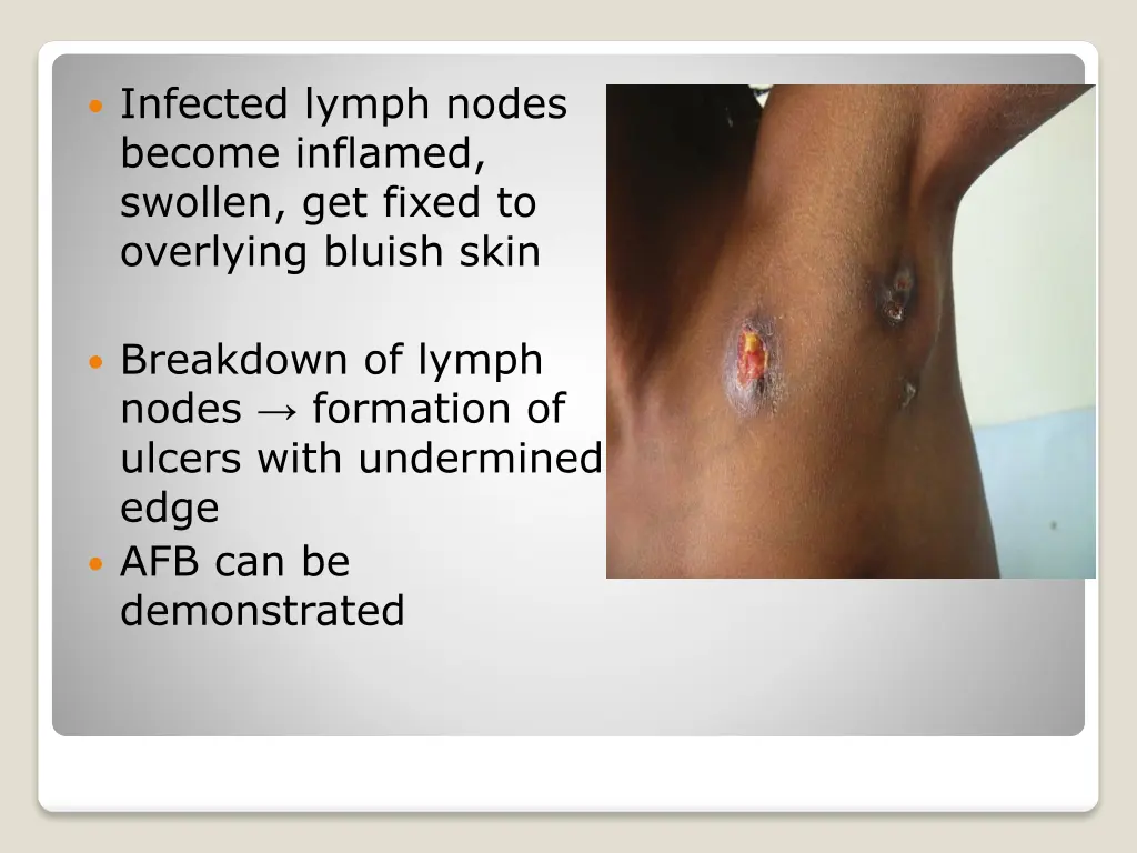 infected lymph nodes become inflamed swollen