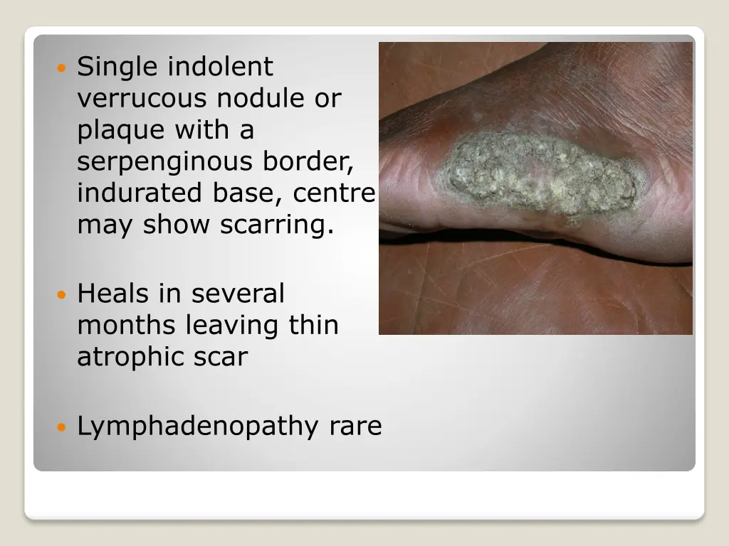 single indolent verrucous nodule or plaque with