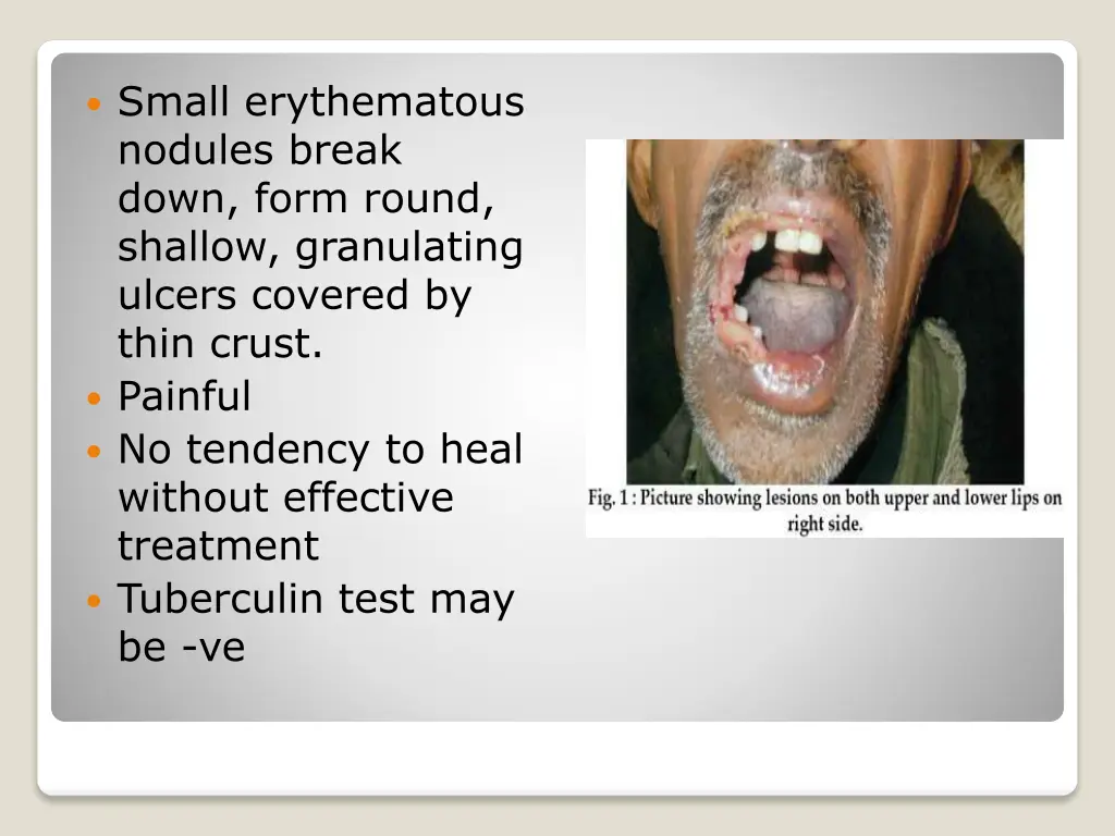 small erythematous nodules break down form round